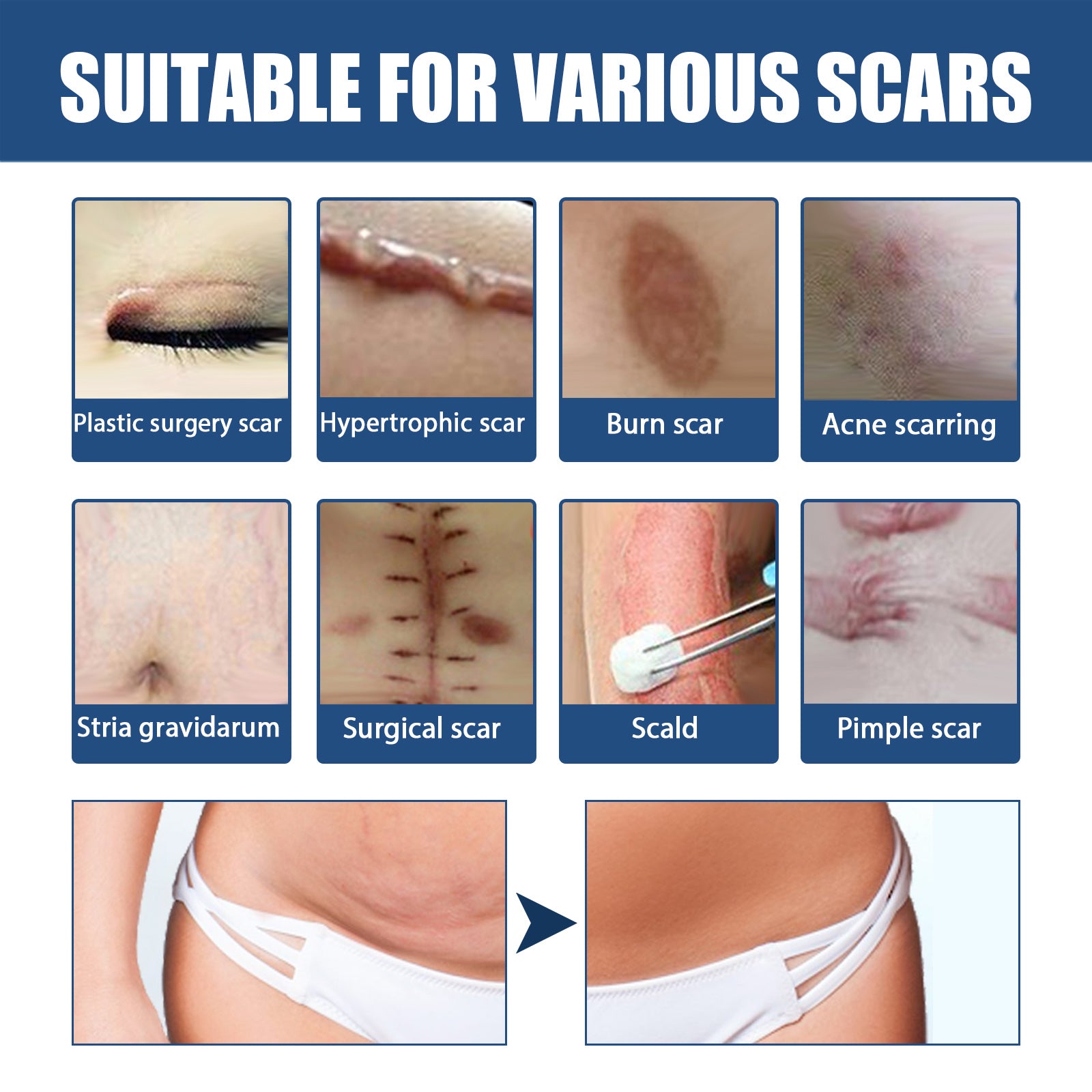 Scar Balm, Surgery Scar Repair Cold Compress Scar Skin Scar Gel Balm