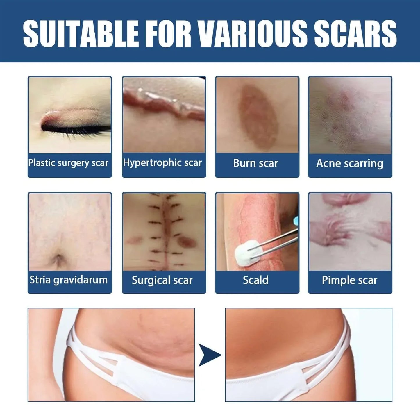 Scar Balm, Surgery Scar Repair Cold Compress Scar Skin Scar Gel Balm default title