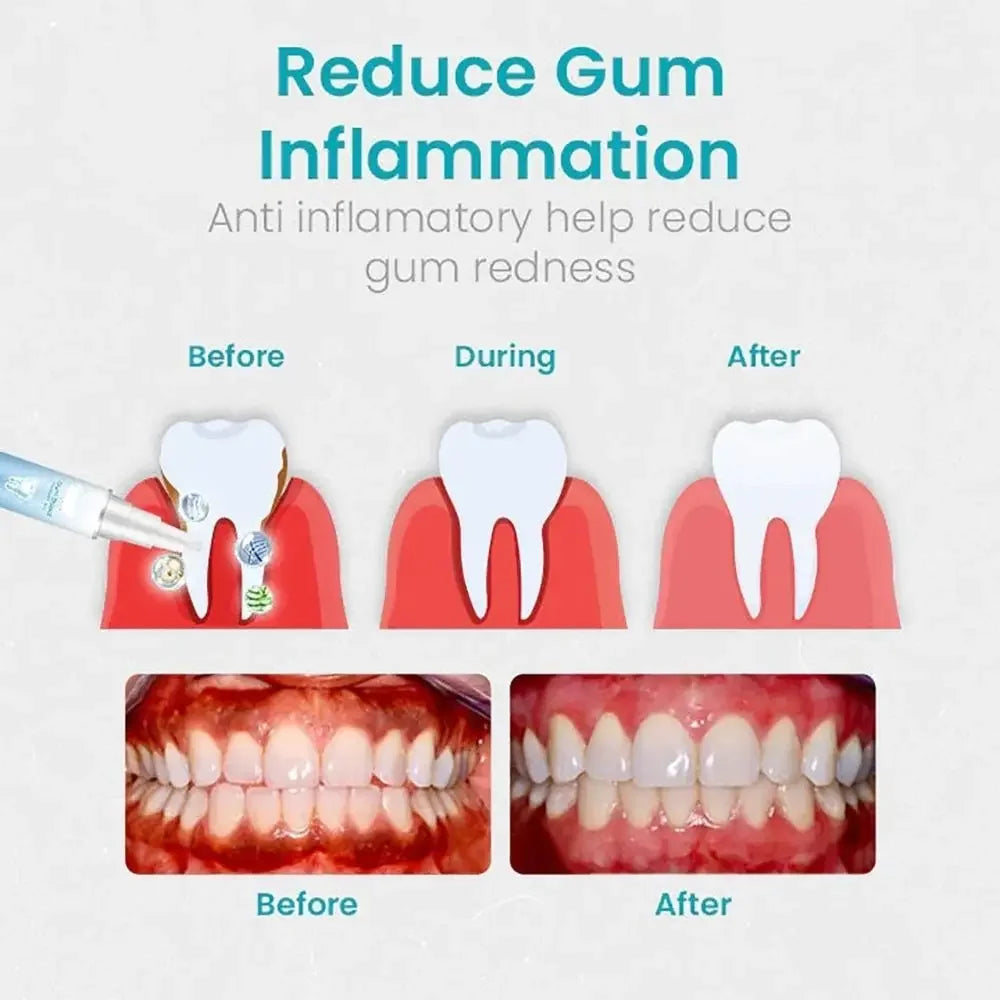 Gum Shield Therapy Gel