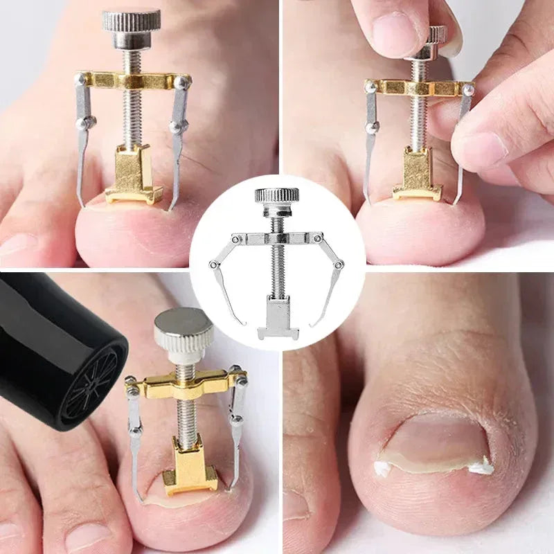 Stainless Steel Nail Ingrown Toenails Corrector Gold