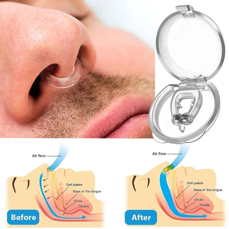 Anti-Snoring Device