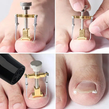 Stainless Steel Nail Ingrown Toenails Corrector Gold