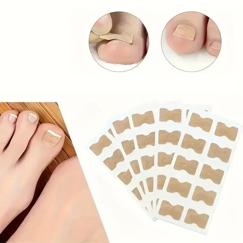 Ingrown Nail Correction Stickers Ivory
