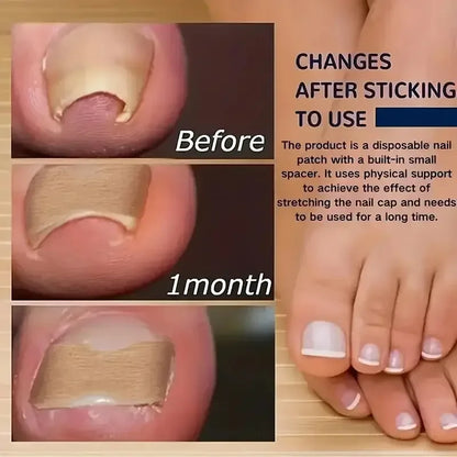 Ingrown Nail Correction Stickers Ivory