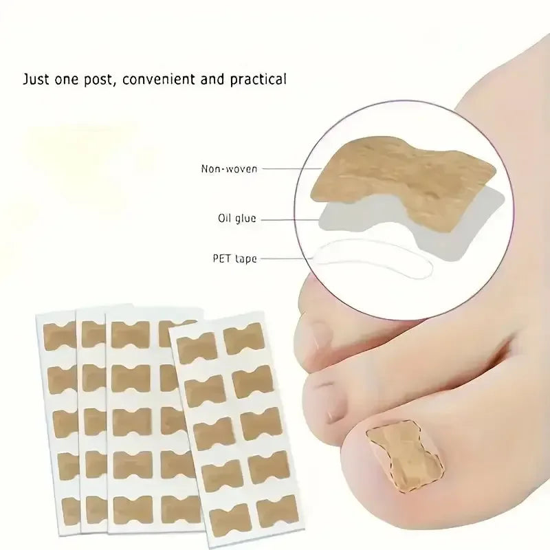 Ingrown Nail Correction Stickers Ivory